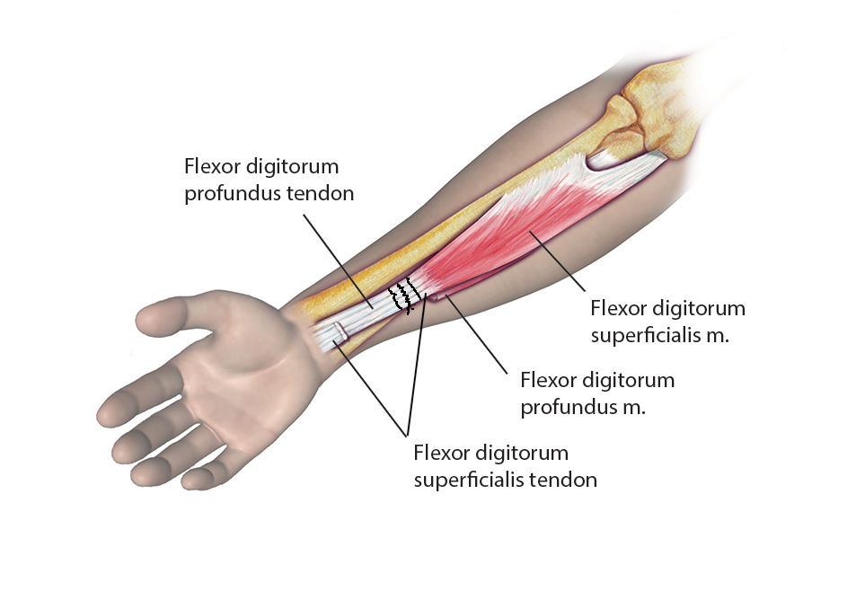 STROKE (CVA) Hand Surgery Resource